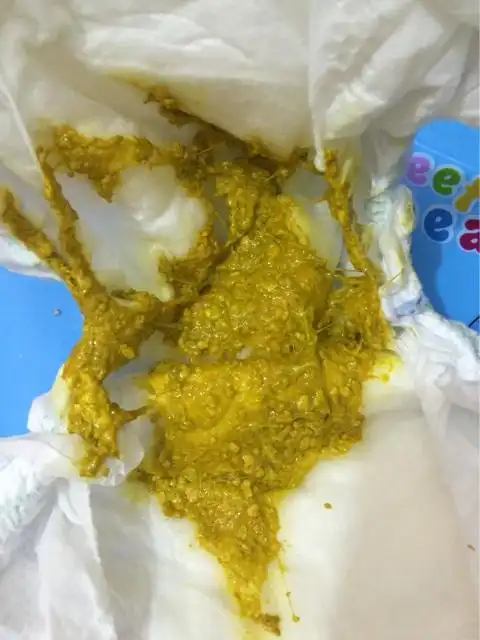 宝宝总是拉这种大便,不知道正常吗?是不是消化不良?有经验的宝妈吗?