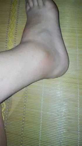 谁能帮我看看我的脚是崴了还是被虫子咬了,怎么回事,有三四天了,肿成