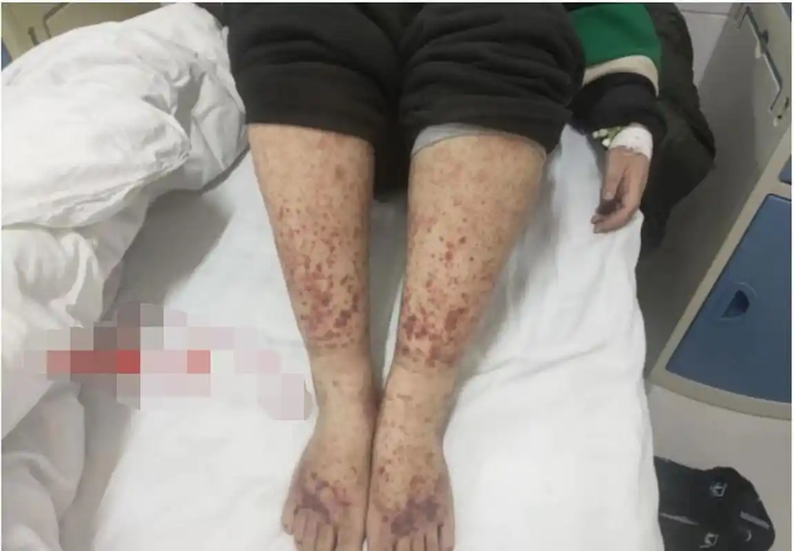 过敏性紫癜咋治好 中西医结合显奇效 门诊经常可以见到过敏性紫癜的患