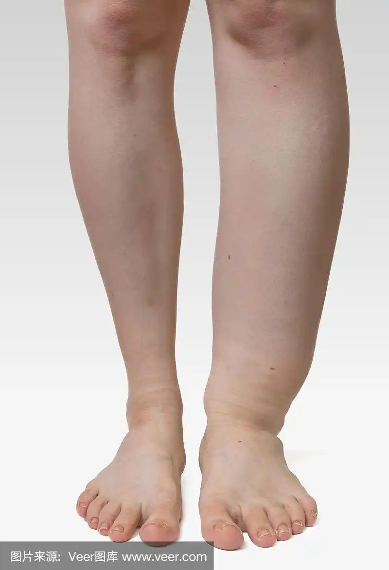 患有水肿的病人的腿.