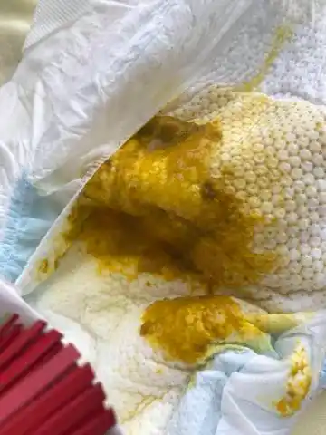 宝宝这两天拉的便便这个颜色,拿去化验说感染脓细胞.