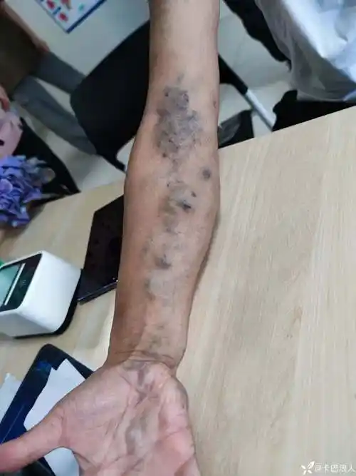 罕见的多发血管瘤