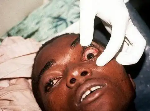 埃博拉病毒怎么消失了 这种病毒患者死亡前一天的样子超恐怖