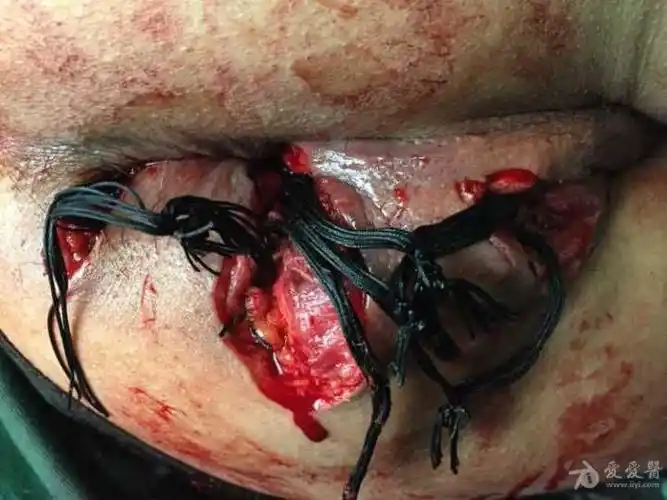 混合痔和肛瘘的手术请前辈指正