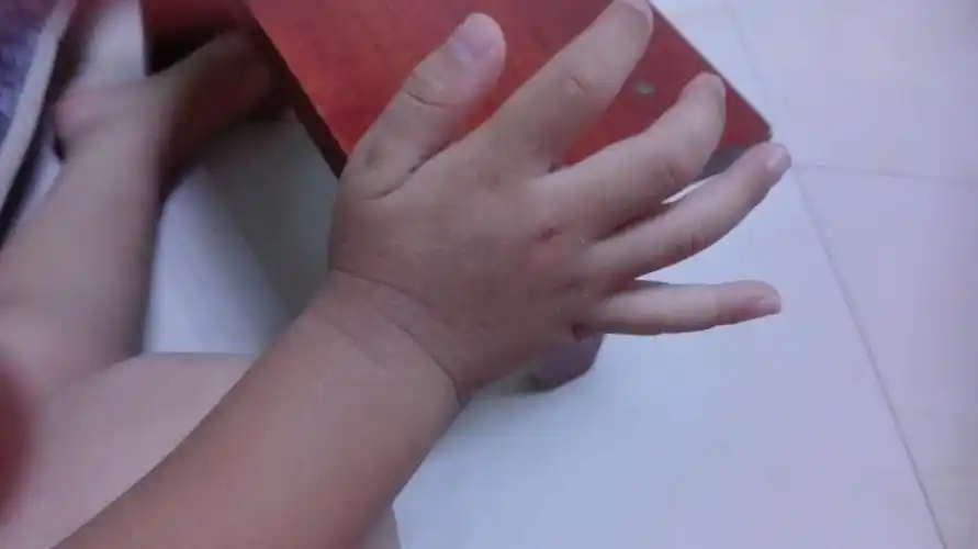 我家男宝宝4岁了.右手背长了小白点不怎么回事?将近一年.不痛不痒