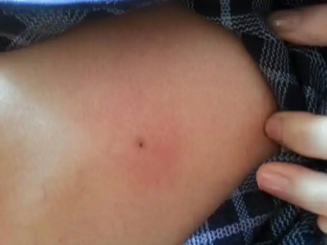 老公后背大脖根第一节脊椎那里去年开始长了个包 黑色的头 像粉刺一样