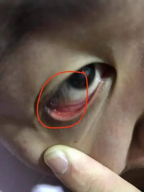 眼睛里面长着白色的东西是什么?