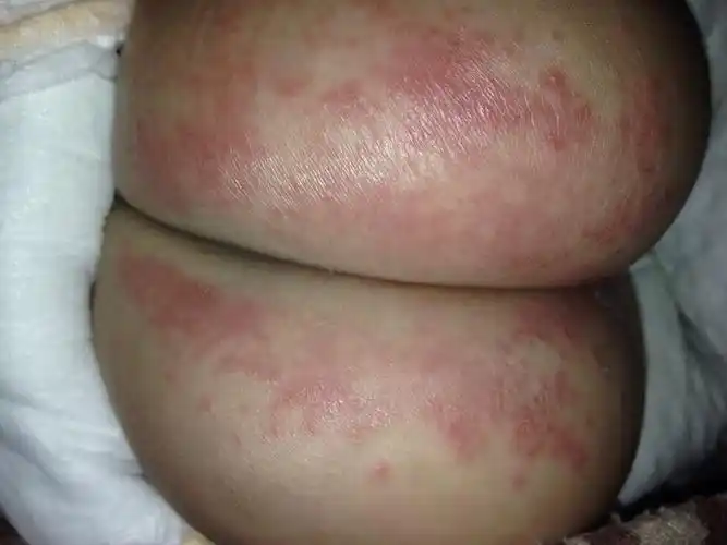 长牙期得了尿布疹,怎么办?_百度宝宝知道