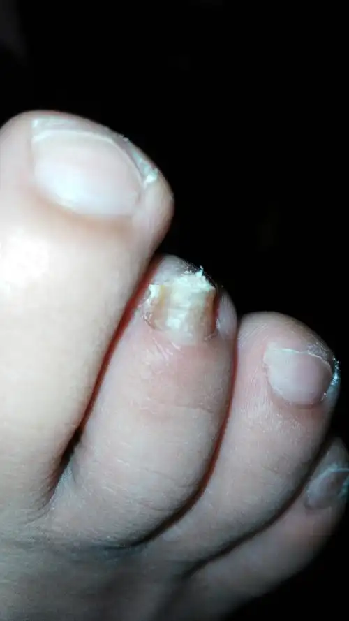 前年右脚脚趾突然变厚,如图,不疼也不痒,咨询下这能看好吗,用什么