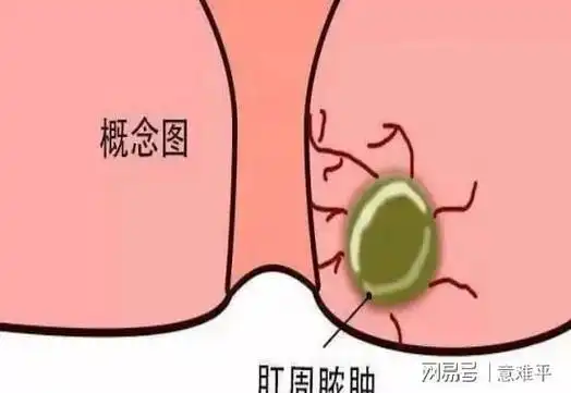 肛门掉出粉色小肉球不痛不痒怎么办教你3个方法自我调理