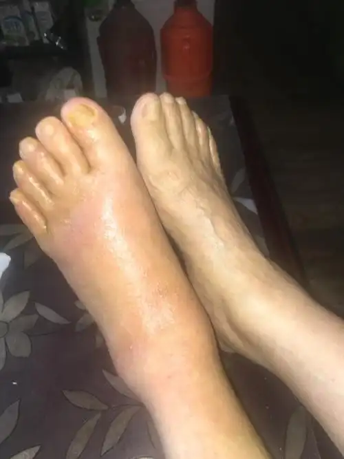 脚上突然很多像水泡的点点,又痒又痛,左脚就肿成这样,现在那个点点在