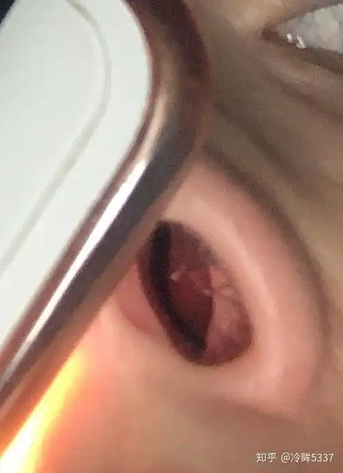 单纯性鼻甲肥大,药物性鼻甲肥大怎么能治好?