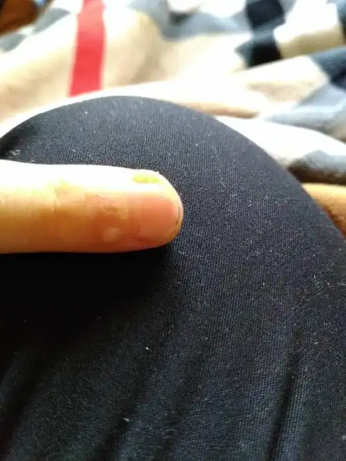 小孩6岁,一个手指头角质化是什么病,约长5毫米宽1.5毫米,像是癣