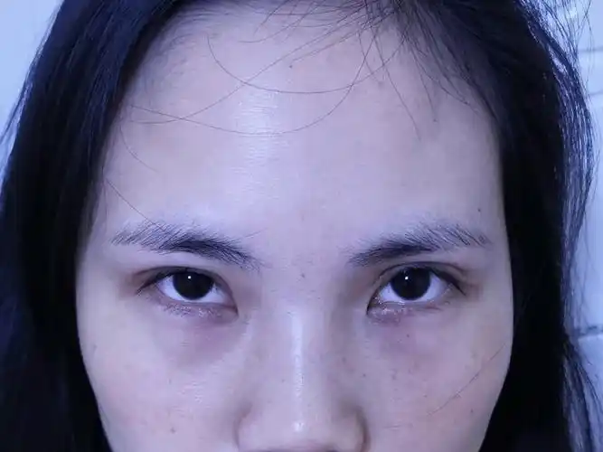 这么凹陷难看的眼睛