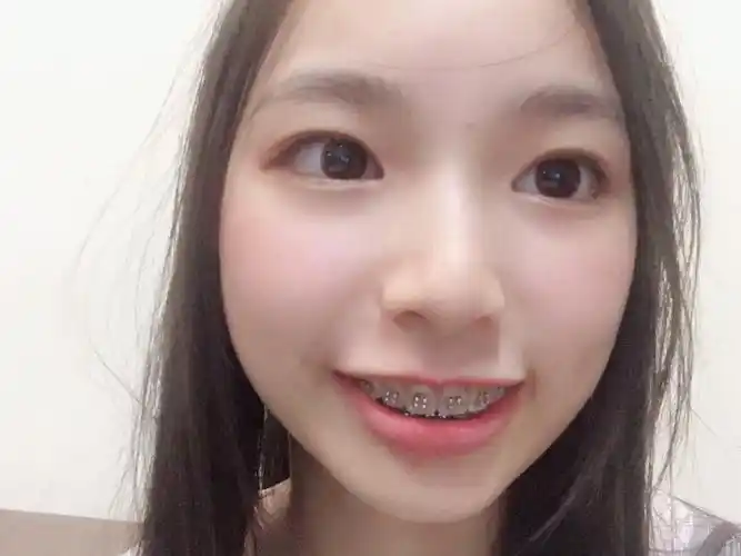 牙套妹的碎碎念这里是一个带牙套一年多的钢牙妹00很多_圈子-新氧