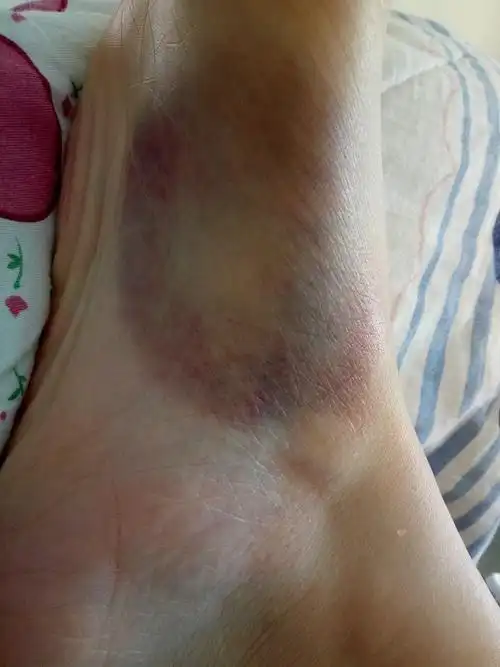 脚掌心突然淤青