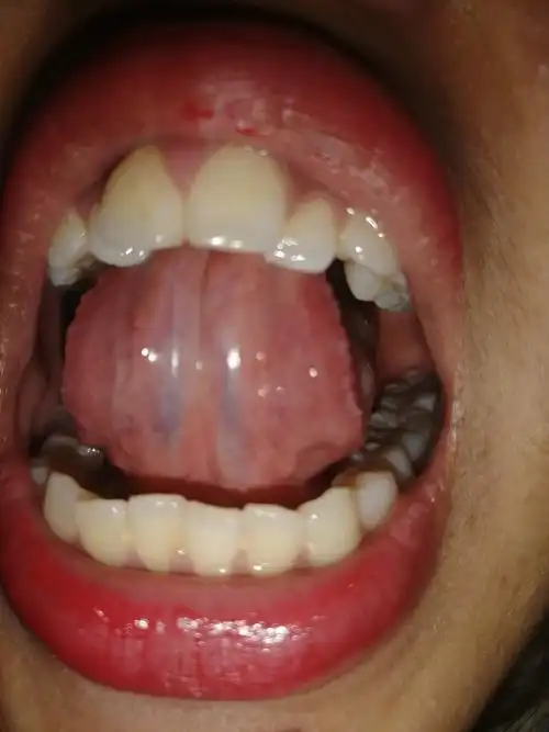 舌下络脉淤血30%