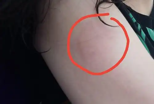 打完第二针 胳膊又红肿块而且痒