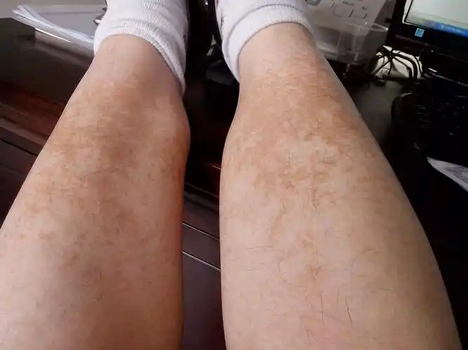 两条小腿在同一个位置长有像癣状的东西,不痛不痒,不知道是什么?