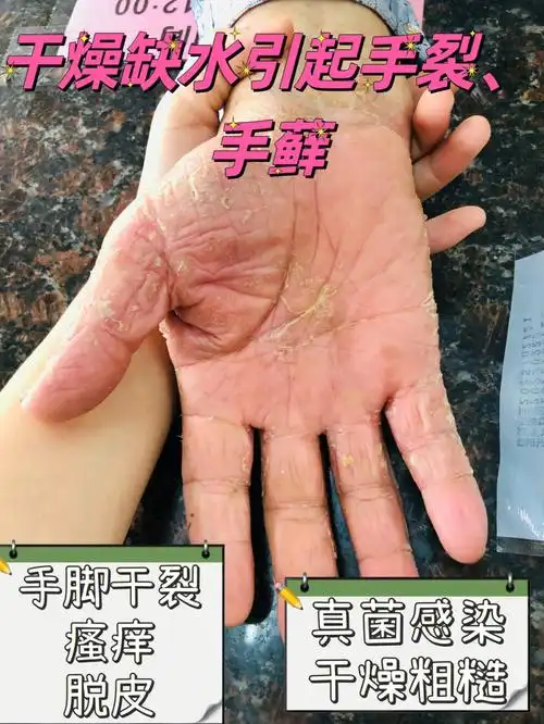 手藓9890697115真菌感染:不严重的:外用药膏就行严重类型