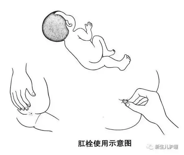 直肠栓剂 用药指导