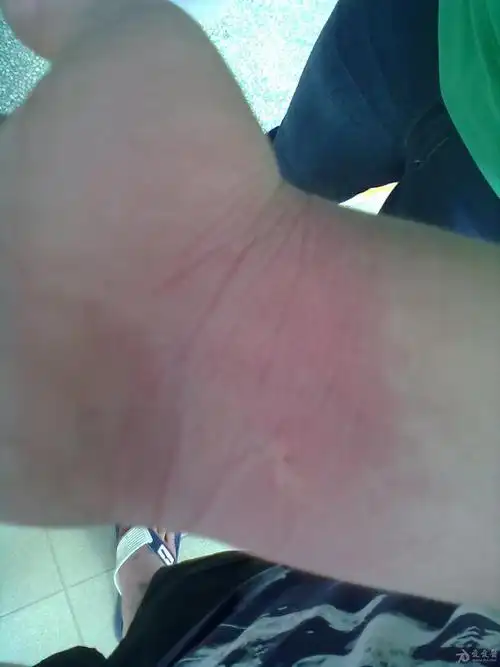 掌跖红斑角化症 一例