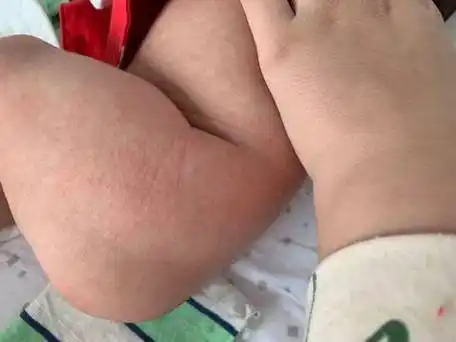 一开始以为纸尿裤过敏,这几天没用了,昨天白天看快没有了,昨天晚上又