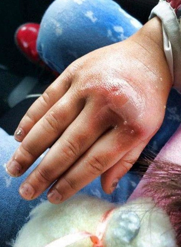 蜂窝组织炎图片 (44)