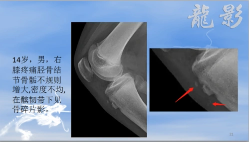 龙影影像公开课——胫骨结节骨软骨炎