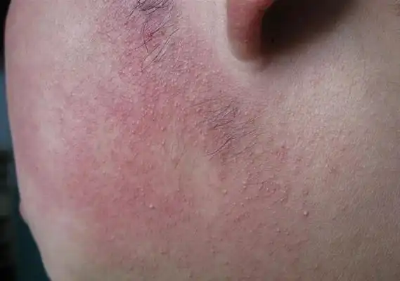 毛周角化症图片39