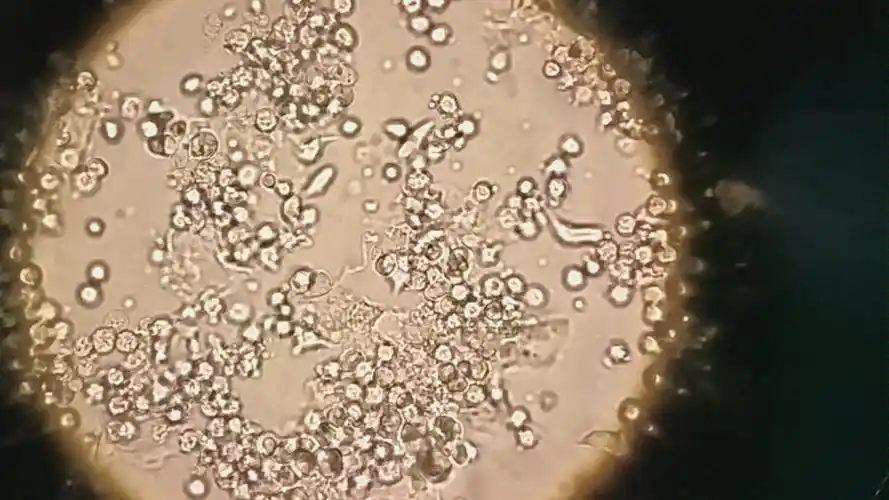 显微镜100倍放大下的阴道毛滴虫