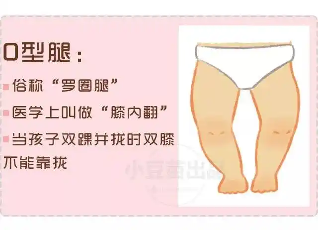 2岁前99的宝宝都是罗圈腿
