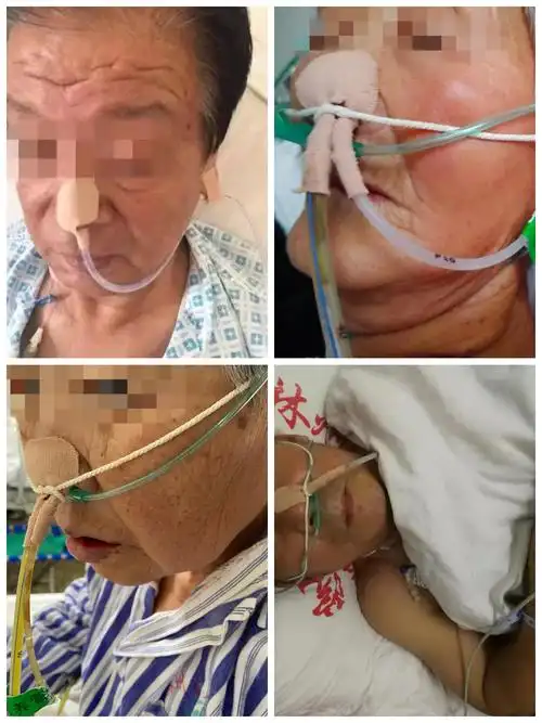 如何有效的固定胃管及肠内营养管