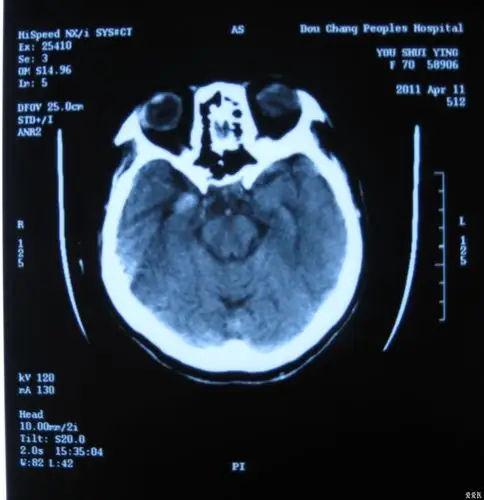 原创颅脑ct片 帮忙看看