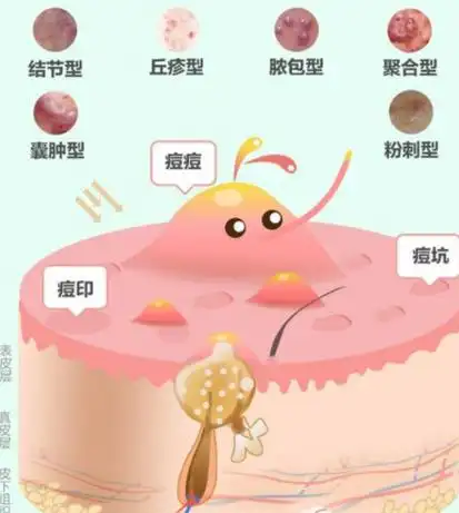 丘疹型痘痘要多久才能自愈?