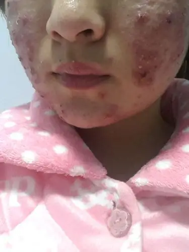 排序 4条回答 今天 09:42黎裙使|一级 楼主  ,你的痘痘真的挺严重的