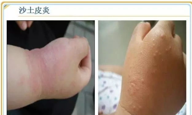 沙土皮炎,医学上又称为"摩擦性苔藓样疹",是夏秋季宝宝常见病之一,其