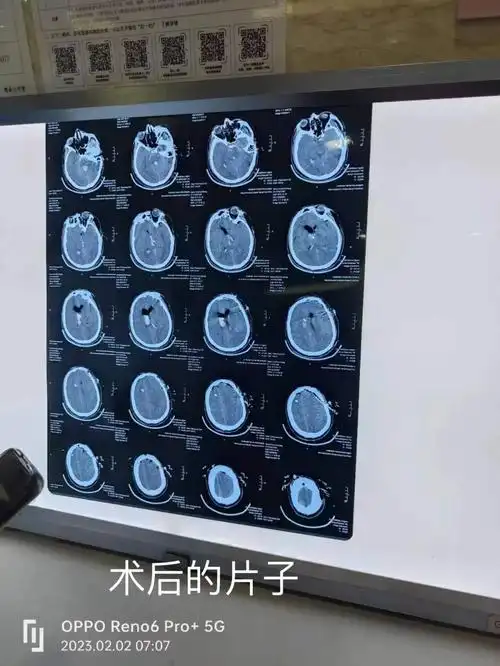 脑出血开颅手术后依旧昏迷家人还能做什么