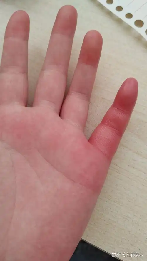 被蚊子咬的手指肿了 - 知乎