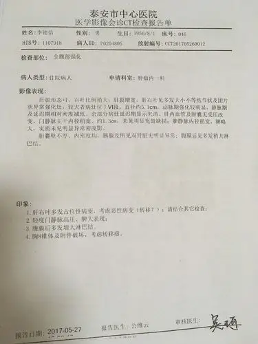 最新肝癌患者李德信病例