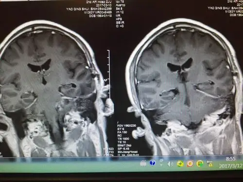 巨大骑跨中后颅窝哑铃型神经鞘瘤全切治疗 - 好大夫在线