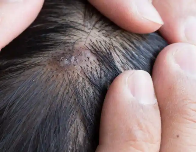 有螨虫的人要注意了头上有这几个症状表明头皮已是螨虫的地盘