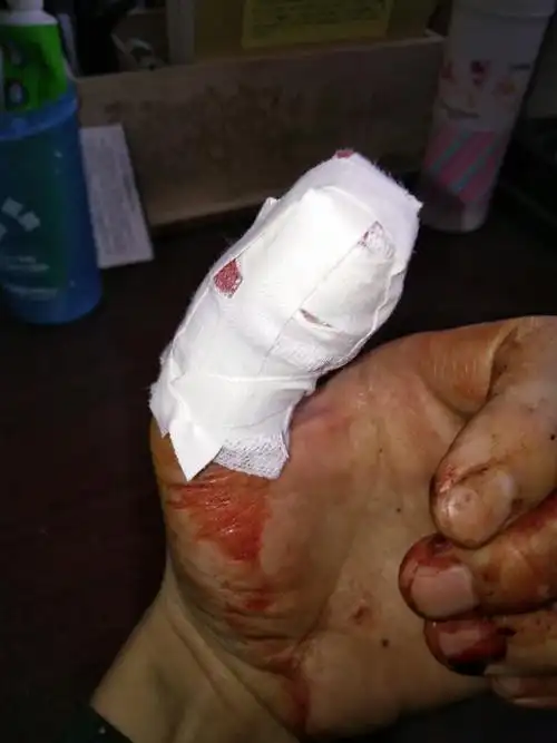 左手大拇指切菜时,切掉有半公分多,大拇指尖都没了,刚刚老总说的门诊