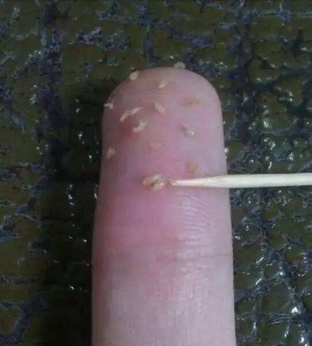 后背经常抠出黄色小米粒是螨虫排出的粪便简直太恶心了