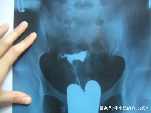 多囊卵巢,一侧输卵管不通,宝妈准备试管却怀孕了,心态很重要