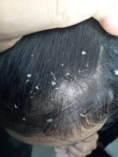 这种头皮屑跟了我半年了,很是烦恼,局部头皮屑发黄,中间一些地方红_百