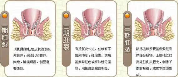 肛裂的症状详解