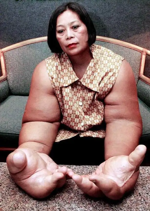 真实版绿巨人:泰国女子拥有"世界上最大的手"