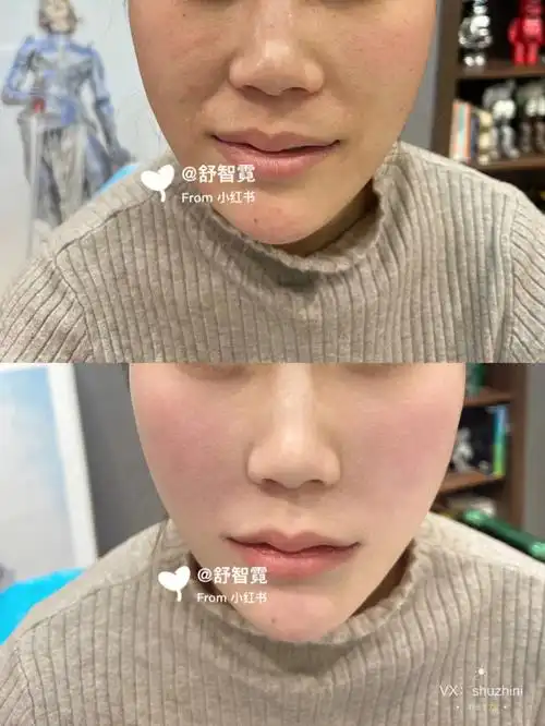 玻尿酸填充鼻基底凹陷