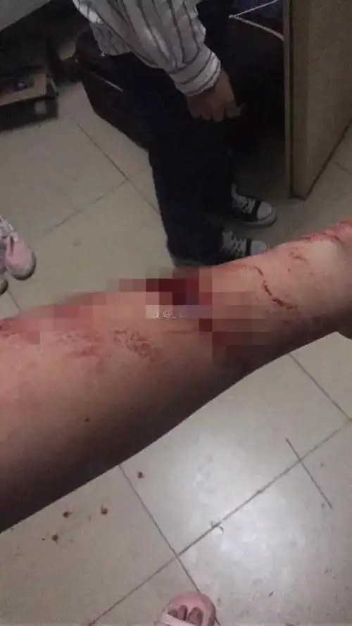 南宁一女大学生在宿舍被刀捅伤疑因抢男友发生矛盾